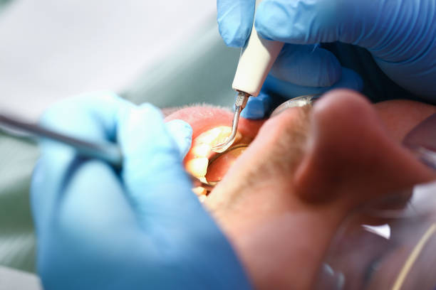 Best Emergency Root Canal Treatment in Jennings, MO