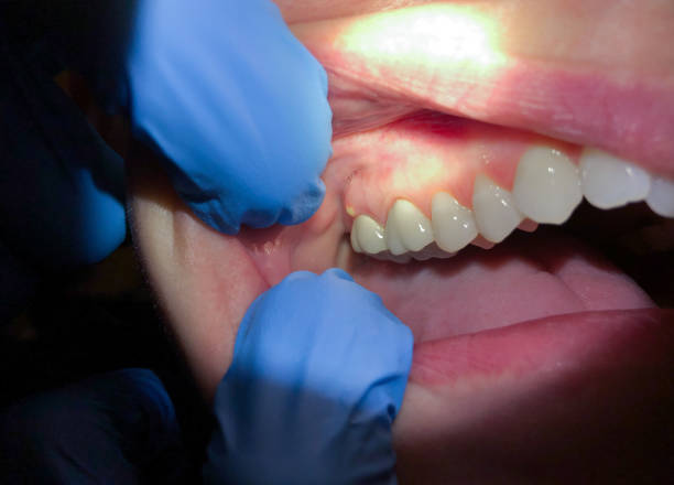 Best Emergency Dental Extractions in Jennings, MO