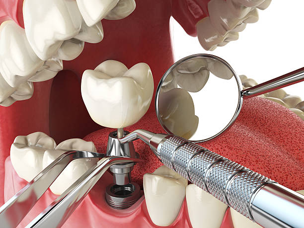 Best Emergency Root Canal Treatment in Jennings, MO